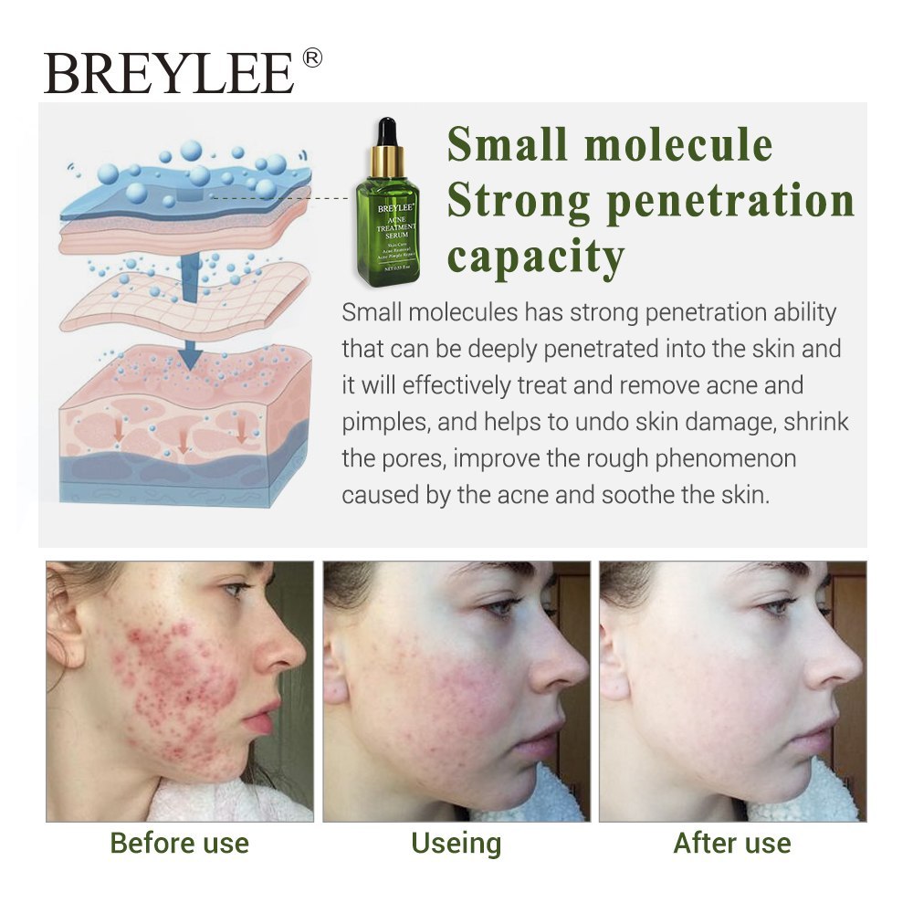 BREYLEE Acne Treatment Serum Face Skin Care