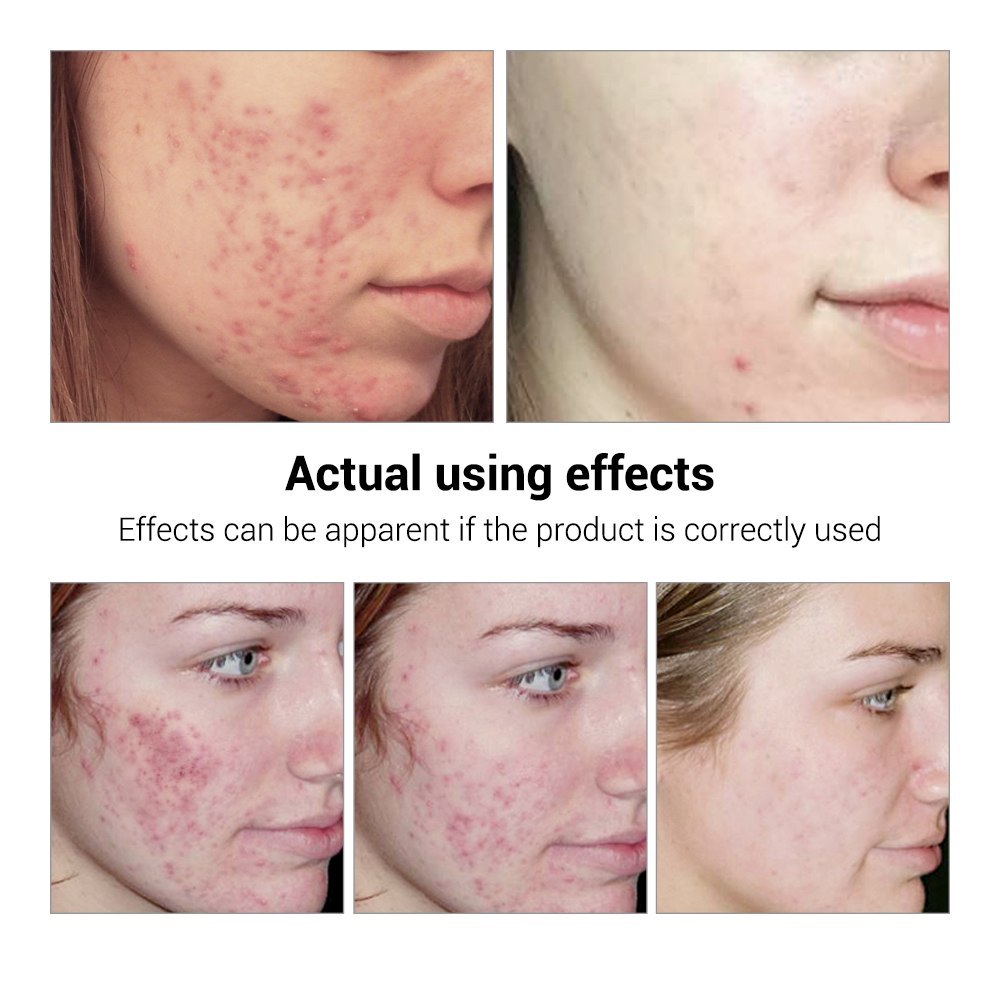 BREYLEE Acne Treatment Serum Face Skin Care