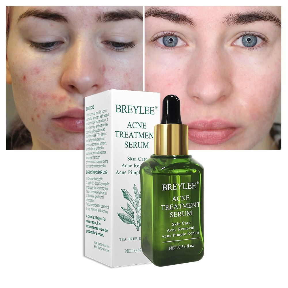 BREYLEE Acne Treatment Serum Face Skin Care