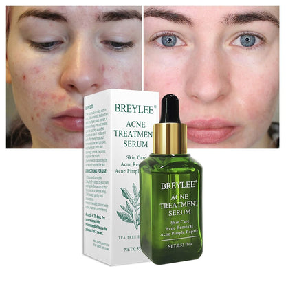 BREYLEE Acne Treatment Serum Face Skin Care